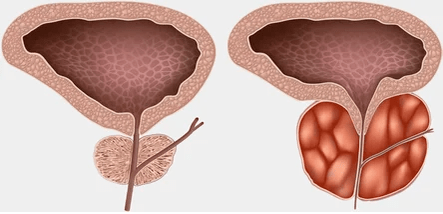 Što je prostatitis