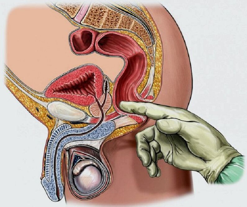 masaža prostate za prostatitis